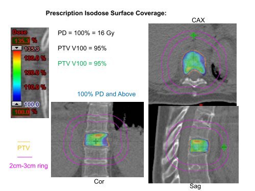 SBRT Treatment Planning: Practical Considerations