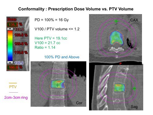 SBRT Treatment Planning: Practical Considerations