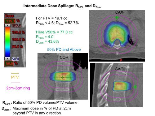 SBRT Treatment Planning: Practical Considerations