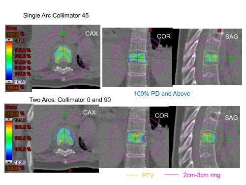 SBRT Treatment Planning: Practical Considerations