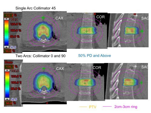 SBRT Treatment Planning: Practical Considerations