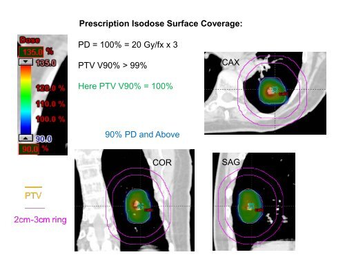 SBRT Treatment Planning: Practical Considerations