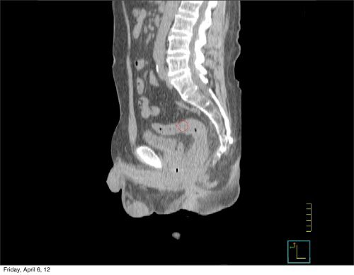 Prostate and Pelvic Lymph Node Anatomy for Contouring