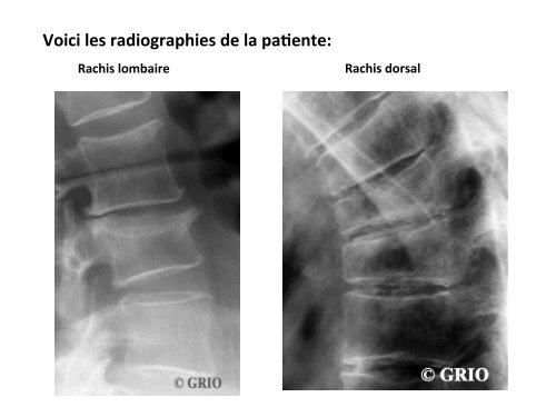 Fracture Tassement Vertébral