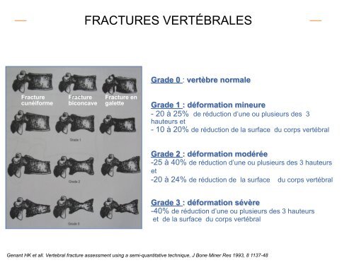 Fracture Tassement Vertébral