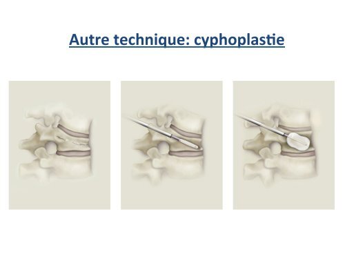 Fracture Tassement Vertébral