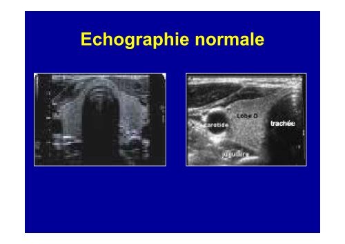 Conduite du diagnostic devant un goitre