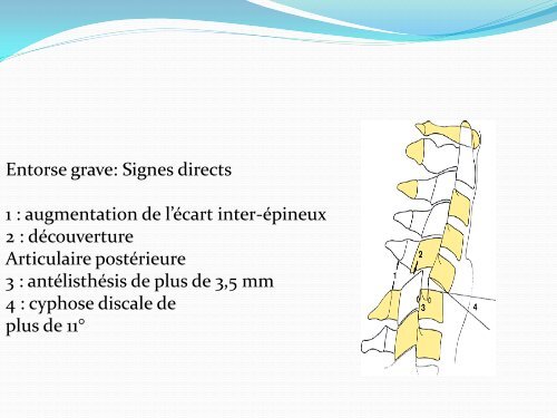 ENTORSE CERVICALE - amase