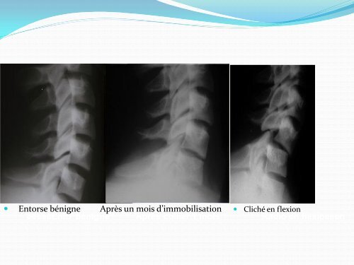 ENTORSE CERVICALE - amase