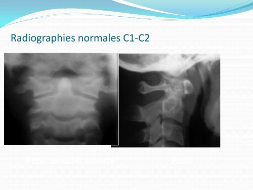 ENTORSE CERVICALE - amase