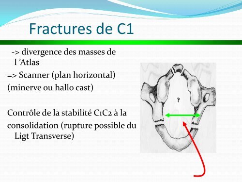 ENTORSE CERVICALE - amase