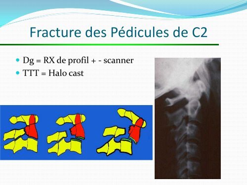 ENTORSE CERVICALE - amase