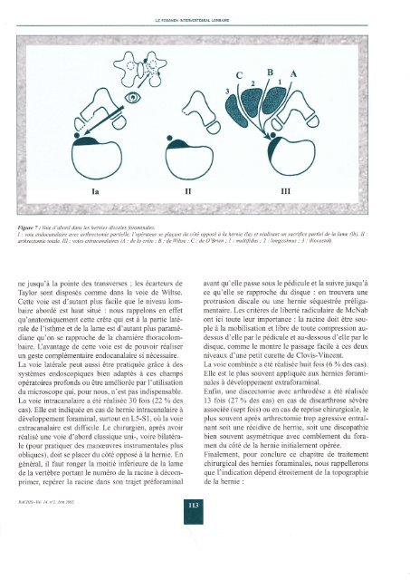 le foramen intervertebral lombaire - L'Institut de la Colonne Vertébrale