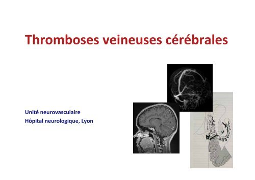 Thromboses veineuses cérébrales