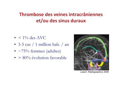 Thromboses veineuses cérébrales