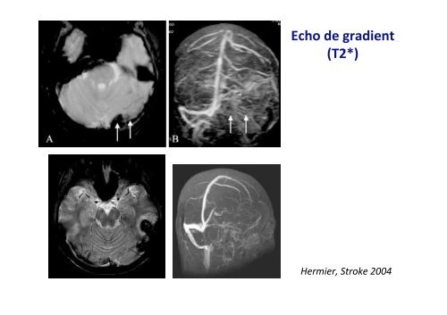 Thromboses veineuses cérébrales