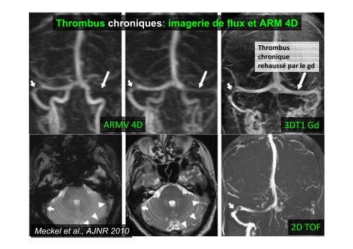 Thromboses veineuses cérébrales