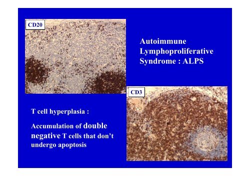 Lymphome Lymphoblastique T enfant et adulte