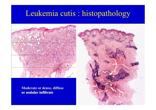 Lymphome Lymphoblastique T enfant et adulte