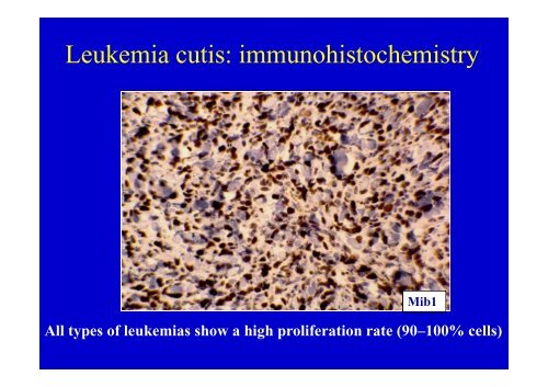 Lymphome Lymphoblastique T enfant et adulte