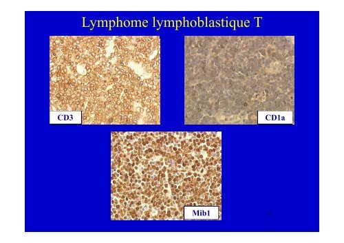 Lymphome Lymphoblastique T enfant et adulte