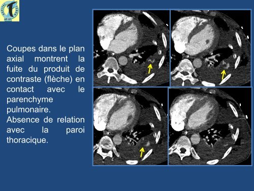 Hémothorax postopératoire : apport de l'imagerie