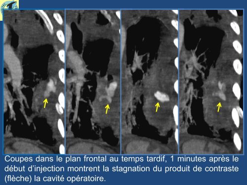 Hémothorax postopératoire : apport de l'imagerie