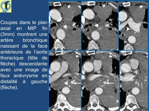 Hémothorax postopératoire : apport de l'imagerie