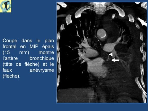 Hémothorax postopératoire : apport de l'imagerie