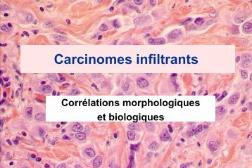 Carcinomes infiltrants du sein - epathologies