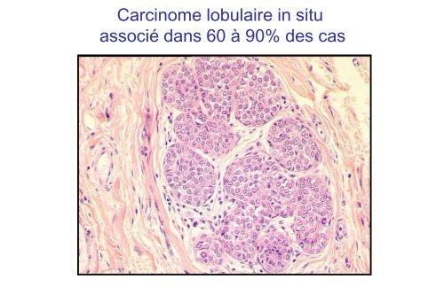 Carcinomes infiltrants du sein - epathologies