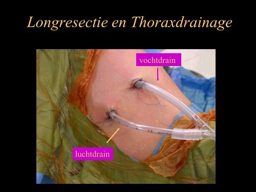 Thoraxdrain - Belsurg