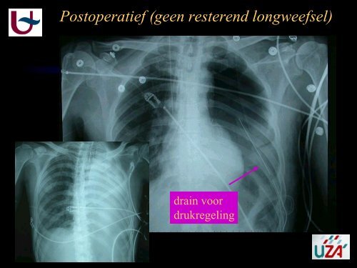 Thoraxdrain - Belsurg