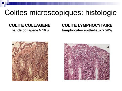 Colites microscopiques - Hepato Web