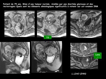 Adénocarcinomes mucineux - RADIOLOGIE BRABOIS