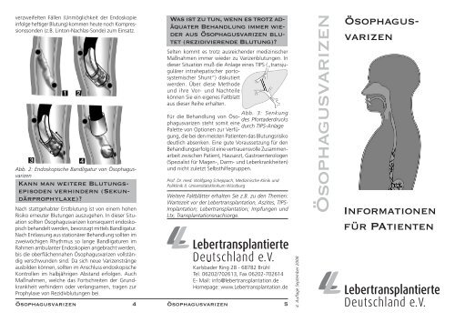 F24 Ösophagusvarizen.indd