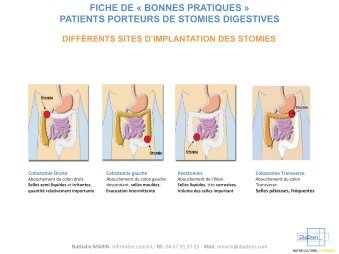 Fiche conseil stomie digestive