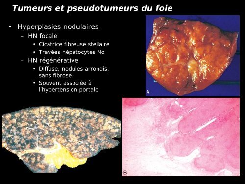 Pathologie du Foie et des voies biliaires - epathologies