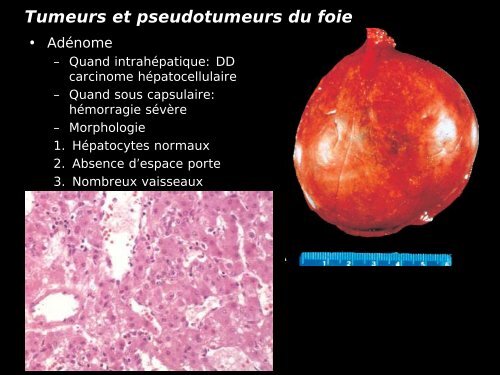 Pathologie du Foie et des voies biliaires - epathologies