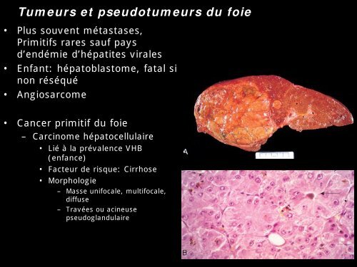 Pathologie du Foie et des voies biliaires - epathologies