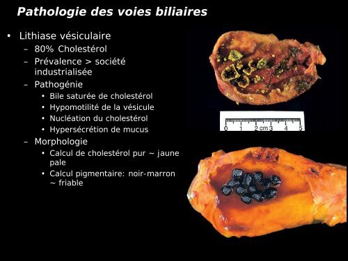 Pathologie du Foie et des voies biliaires - epathologies