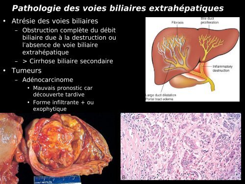 Pathologie du Foie et des voies biliaires - epathologies