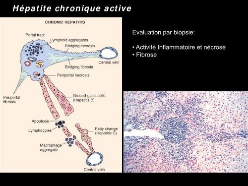 Pathologie du Foie et des voies biliaires - epathologies