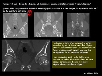 LM CC ostéo-artic ostéopoecilie ponctuée - RADIOLOGIE BRABOIS