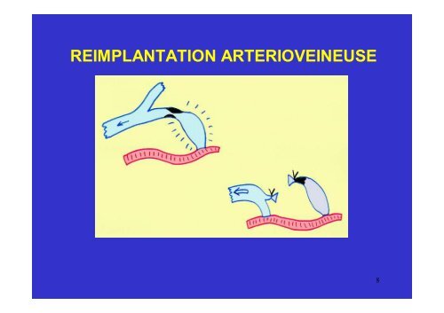 La sténose infranchissable - SFAV