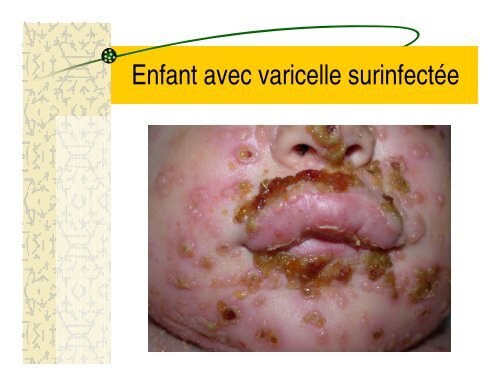 La varicelle: une maladie bénigne, vous dites? - CHU Sainte-Justine