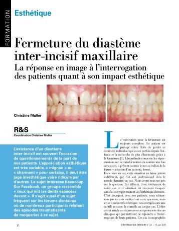 Fermeture du diastème inter-incisif maxillaire - ONFOC 64