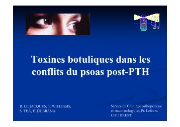 Injection de toxines botuliques dans les conflits du psoas - GECO