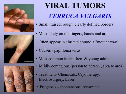 Benign skin tumor ( non – vascular )