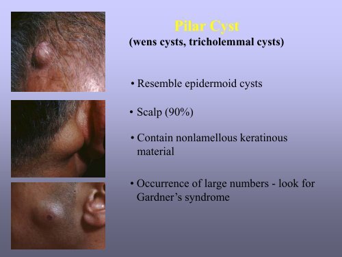 Benign skin tumor ( non – vascular )